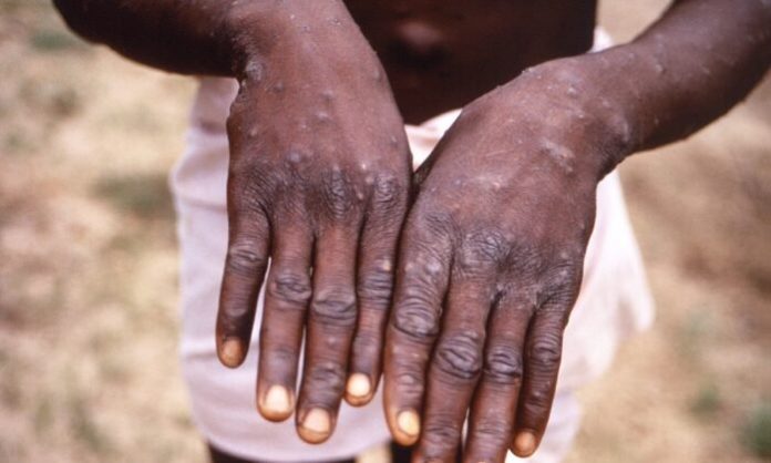 cdc-backtracks-on-non-airborne-monkeypox-mask-guidance-after-criticism