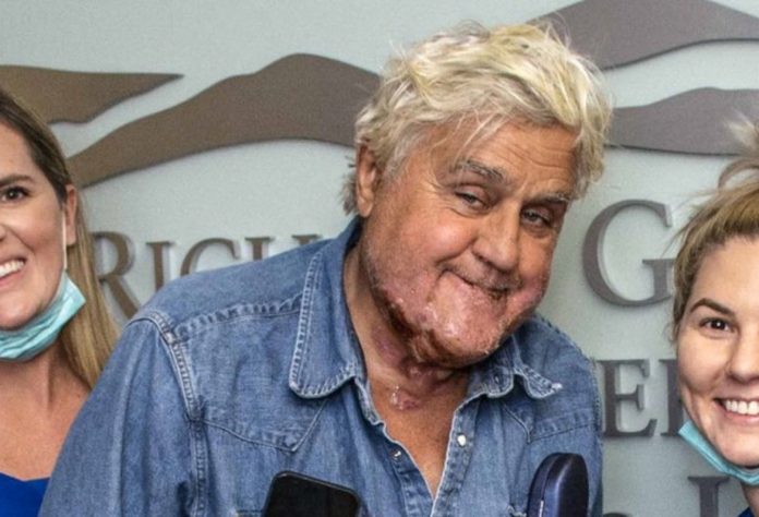 jay-leno-released-from-hospital-badly-scarred-from-car-fire