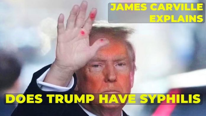 left-wing-media-freaks-over-‘mysterious-red-marks’-on-trump’s-hand–-dem-strategist-james-carville-claims-it-looks-like-syphilis-(video)